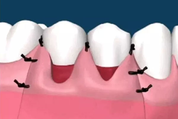 怎么减缓牙龈萎缩症状(怎么减缓牙龈