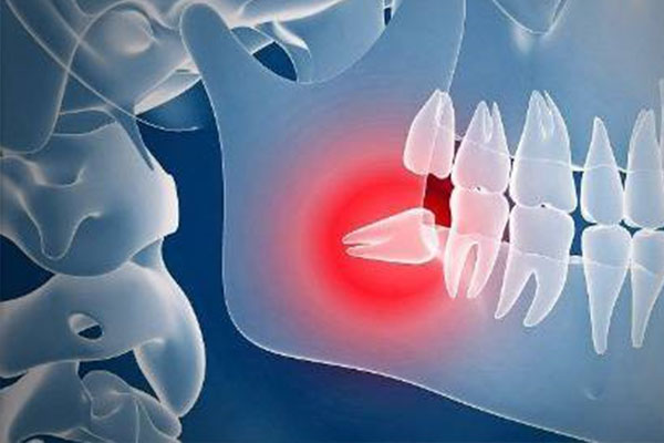 如何看智齿是否长歪(如何看智齿是否
