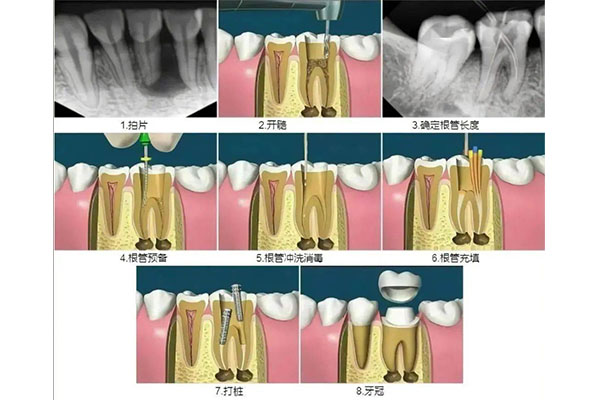做根管治疗带牙套大概多少钱(做根管治疗带牙套大概多少钱一颗
