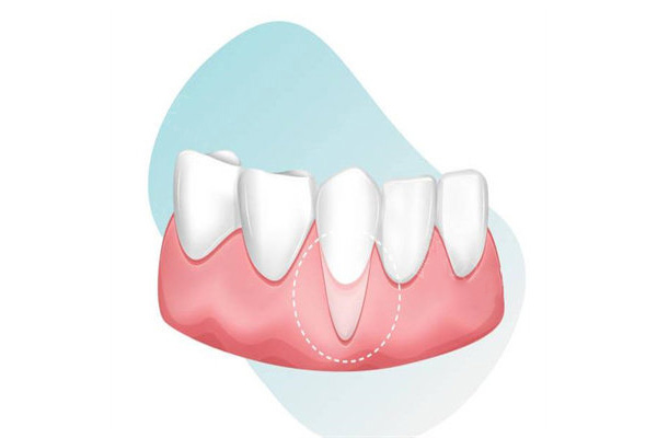 安利牙膏对牙龈萎缩有效果吗(安利牙膏对牙龈萎缩有效果吗图片