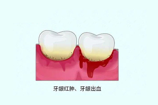 刷牙容易牙龈出血是什么原因导致的呢