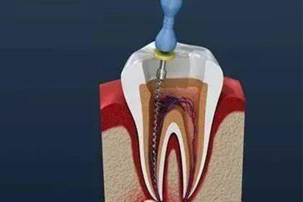 做过根管治疗的牙再次补,还要做根管治疗吗(补好的牙齿做根管