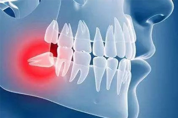 垂直阻生牙是什么意思(垂直阻生牙图