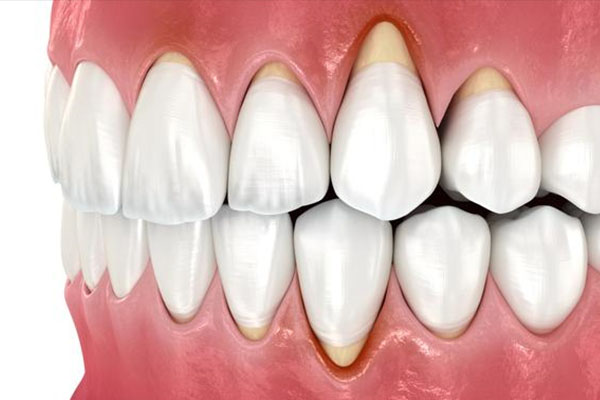 怀孕牙龈萎缩怎么恢复正常吗吃什么