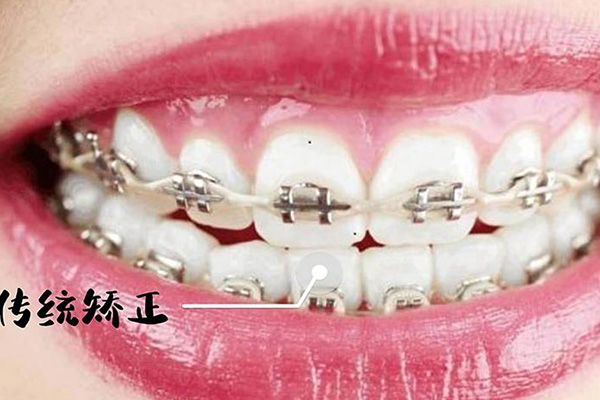 龅牙导致嘴唇厚可以治好吗(龅牙导致