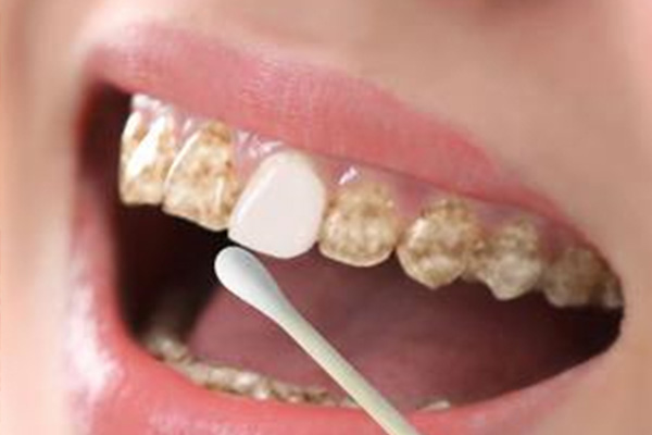 多西环素牙齿变黄可逆吗(多西环素 牙齿变黄的概率)