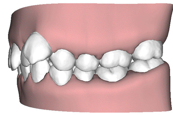 地包天截骨手术多久恢复(地包天手术截骨后能完全长好吗)
