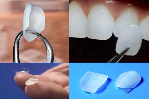 牙贴面做多少颗(牙贴面做多少颗好