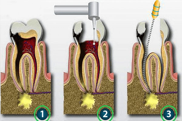 做过根管的牙根尖炎怎么治疗呢(做过根管的牙根尖炎怎么治疗呢