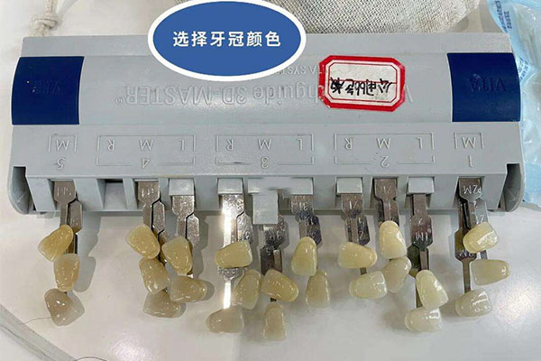 四环素牙分级(四环素牙程度分级)