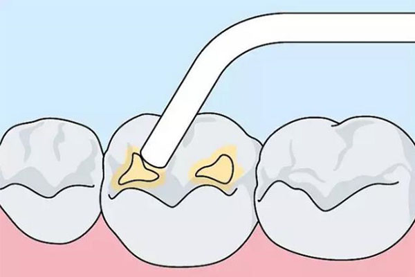 儿童做窝沟封闭挂什么科(儿童做窝沟封闭挂哪个科)