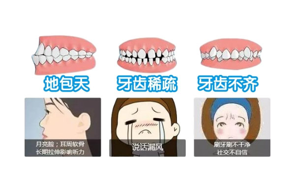 地包天戴牙套一般要多久(地包天带牙