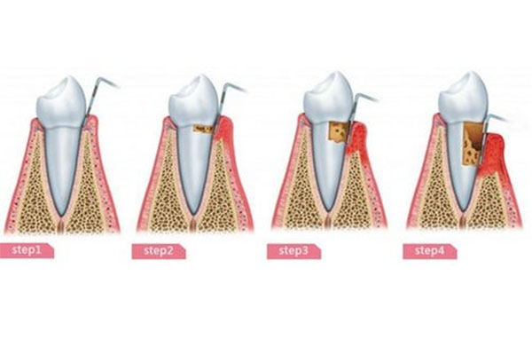 年轻人牙龈萎缩牙齿松动怎么办呢吃什么药(年轻人牙龈萎缩牙齿