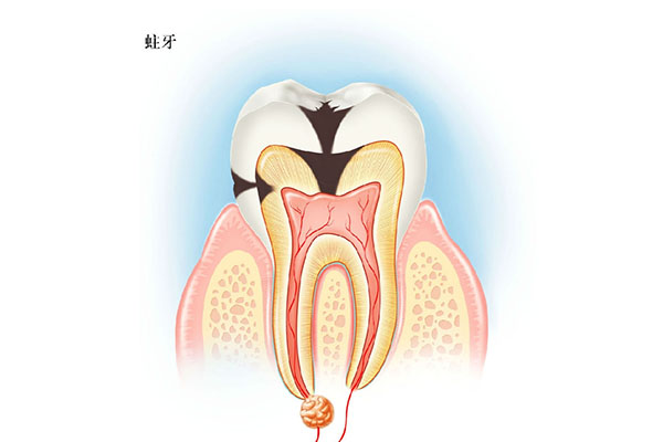 两岁宝宝蛀牙了(两岁宝宝蛀牙了需要