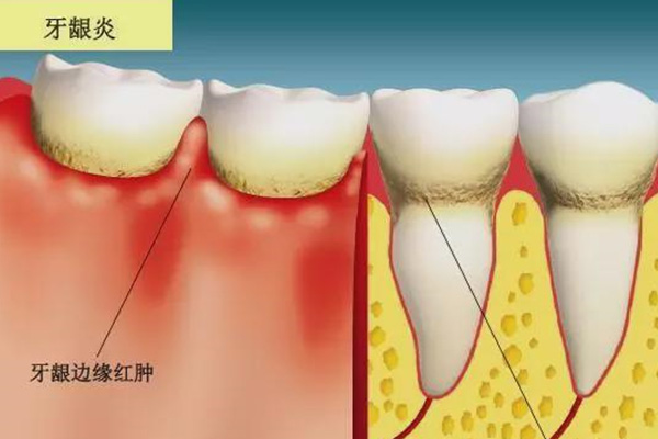 刷牙时出血是什么原因分析