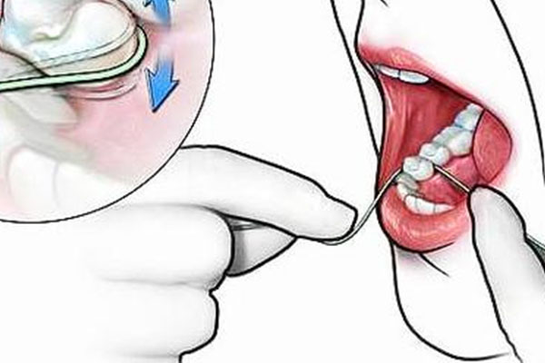 急性牙髓炎可以立即拔除吗(急性牙髓