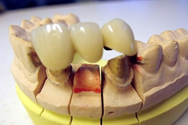 全瓷牙能摘下重新粘吗(全瓷牙可以摘下来吗)