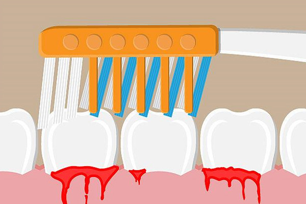 刷牙牙龈出血用什么牙膏效果最好