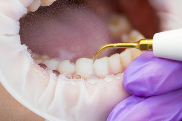 深圳市人民医院洗牙价格揭秘 | 中老年口腔种植牙性价比高