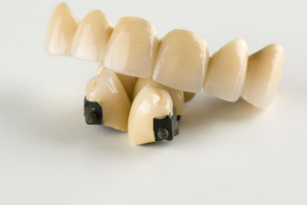 中老年口腔批量种植技术：烤瓷牙安