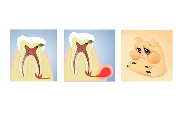 中老年口腔：快速止牙疼的药，解决牙齿缺失烦恼