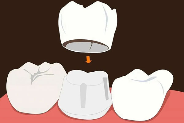 树脂补牙真的会有异味吗？中老年口腔专家为您解答