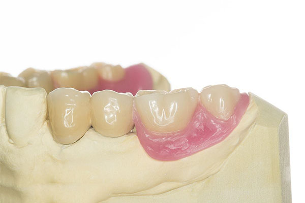 活动义齿不舒服怎么办？中老年口腔教您轻松缓解不适