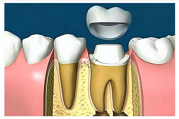 北京补牙纳入医保了吗？中老年种牙
