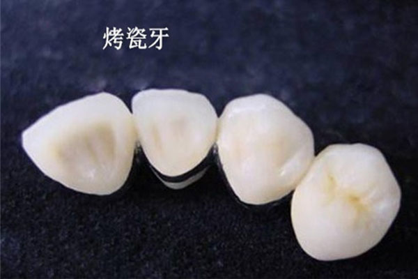 义获嘉树脂牙VS松风塑钢牙 中老年口