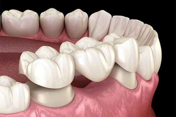镶牙医保能报销吗？中老年口腔为您解答！