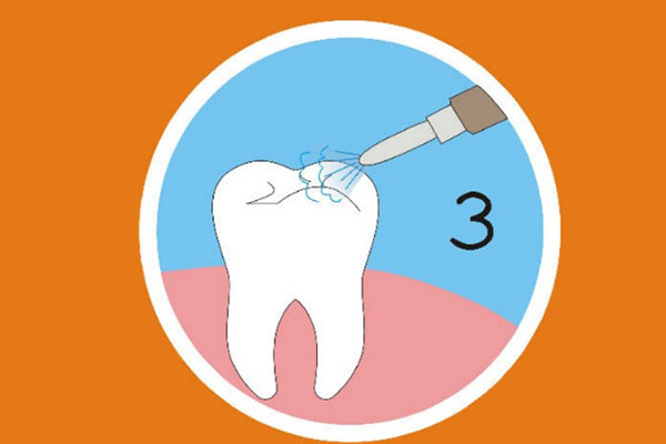 牙齿涂氟适合哪些年龄段？中老年口