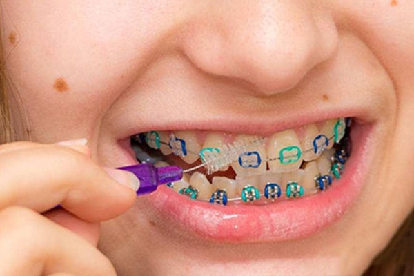 杭州正畸专家揭秘中老年人缺牙高效解决方案：批量修复不伤邻