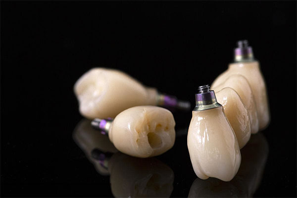 种牙最后一步安装牙冠多久换一次