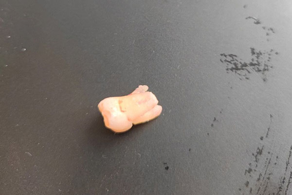 活动假牙后牙松动疼痛难忍？中老年口腔高效批量修复方案让您