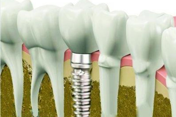 女生多少岁可以种牙？中老年口腔为您解答种植牙年龄限制