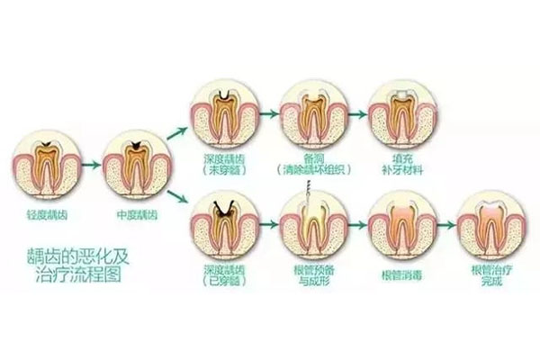 中老年口腔专家支招：5岁儿童牙齿有龋齿黑洞怎么办？