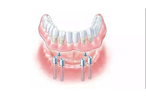 中老年口腔种牙指南库：高效解决牙