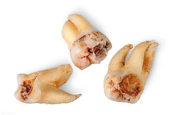 拔了智齿几天后可以吃饭？中老年口腔为您解答术后饮食恢复建