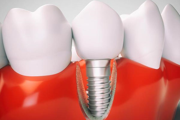 中老年种牙到底要多久？高效解决缺