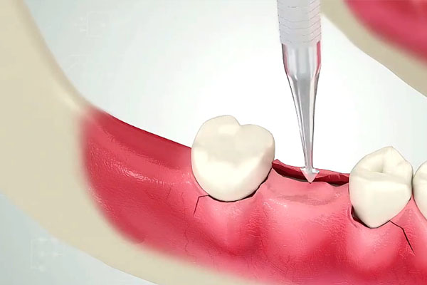 牙齿血凝块脱落时间揭秘 中老年缺牙