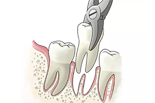 智齿不阻生也要拔？中老年口腔批量修复方案省时省力
