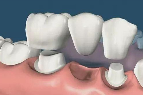 大庆镶牙哪里便宜？中老年口腔为您