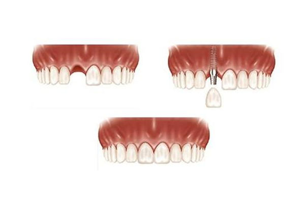 种牙可以报销医疗保险？中老年口腔