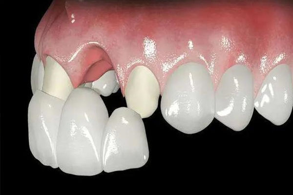 拔牙后多久能种牙或镶牙？中老年口