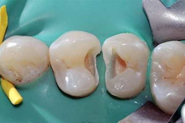 南宁市补牙哪家医院好？中老年口腔