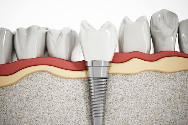 意大利种植牙品牌排行榜揭晓：中老