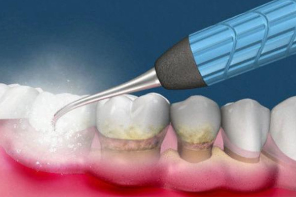中老年口腔：私人洗牙到底卫不卫生