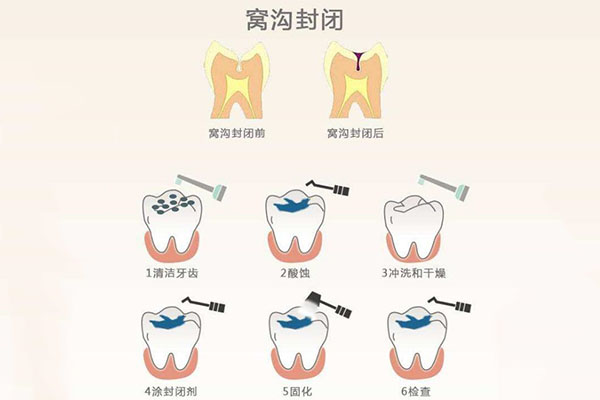 小孩体检牙齿涂氟要注意什么问题？中老年口腔专家提醒：这样