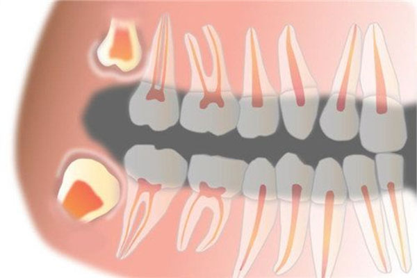 智齿生长痛要忍多久？中老年口腔为您高效解决缺牙烦恼