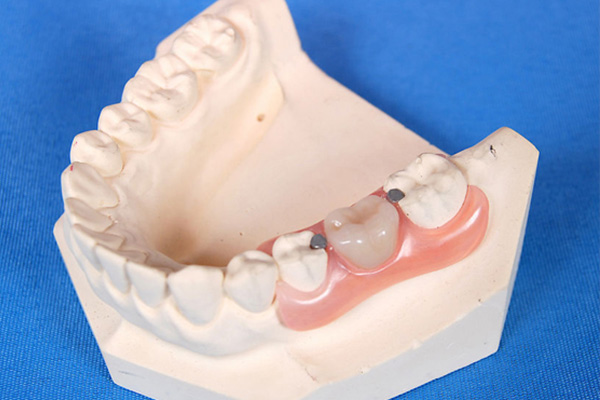 树脂活动假牙的优缺点深度解析：中